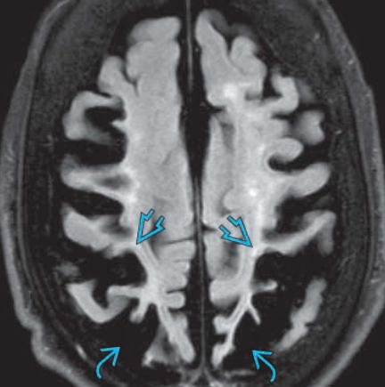Thoái hóa vỏ não hạch nền (Corticobasal Degeneration - CBD)