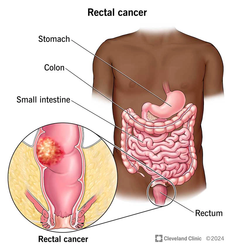 Phân loại giai đoạn ung thư trực tràng (Rectal cancer (staging))