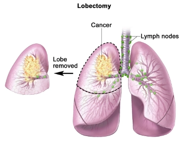 Phẫu thuật cắt thùy phổi (Lobectomy)