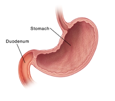 Viêm tá tràng (Duodenitis)