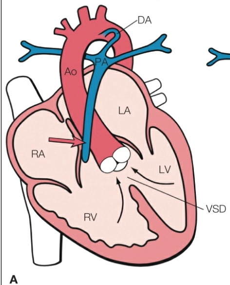 Teo van Động Mạch Phổi kèm Thông Liên Thất