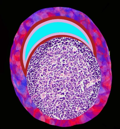 Viêm tiểu phế quản thể nang (Follicular bronchiolitis - FB)