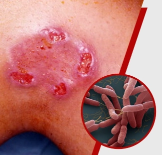 Viêm phổi Melioidosis