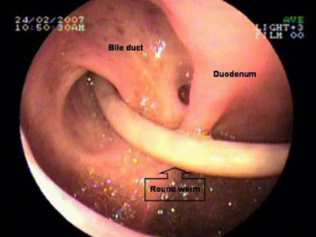 Giun đũa đường mật (Biliary ascariasis)