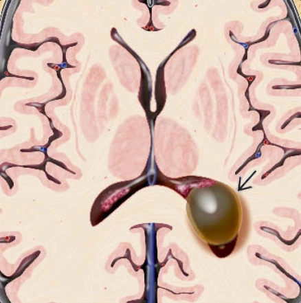 Nang màng não thất (Ependymal cysts) 