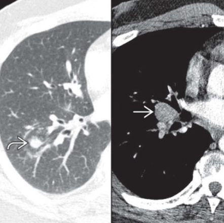 Viêm phổi do nấm Histoplasma