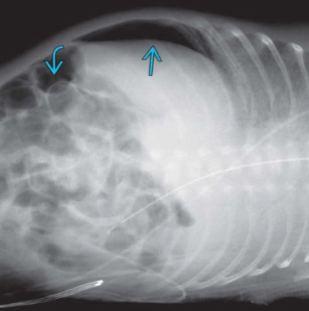 Dấu hiệu Cupola (Bụng) - Cupola sign