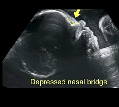Bất sản sụn/ thiểu sản sụn ở thai nhi (Achondrogenesis &amp; Hypochondrogenesis)