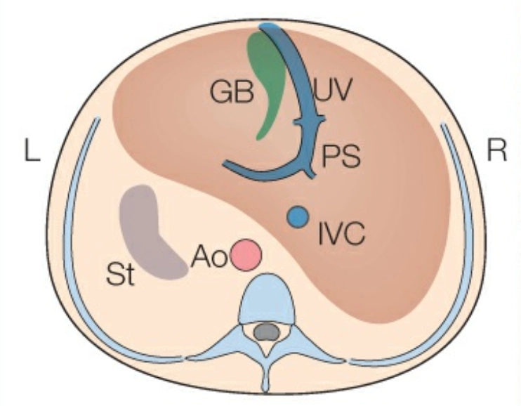 Tồn tại tĩnh mạch rốn phải (PRUV)