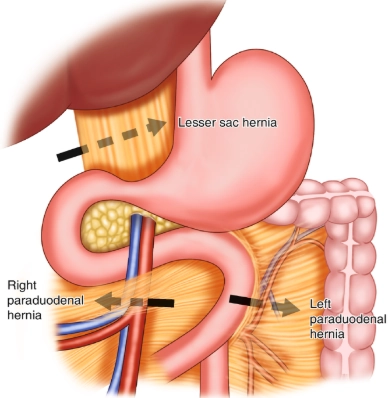 Thoát vị hậu cung mạc nối (Lesser sac hernia / Foramen of Winslow Hernia)