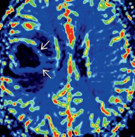 U lympho hệ thần kinh trung ương liên quan đến suy giảm miễn dịch (Immunodeficiency-associated CNS lymphomas)