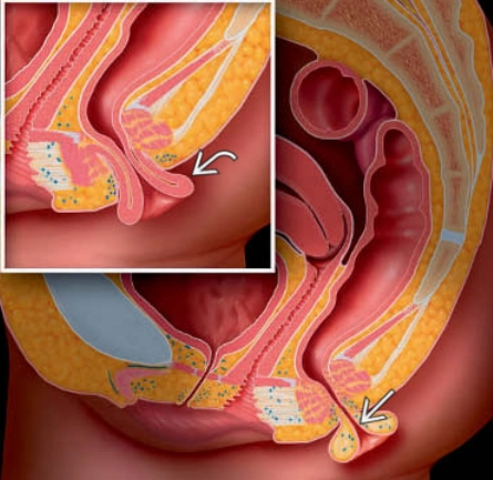 Sa trực tràng (Rectal prolapse)
