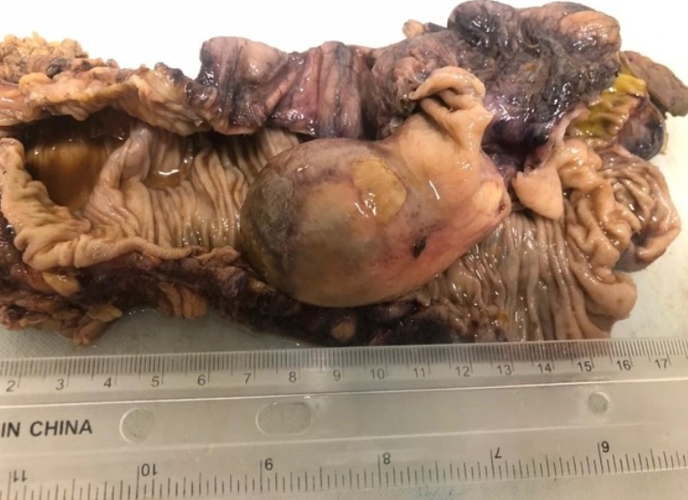 U mỡ đường tiêu hóa (Gastrointestinal tract lipomas)