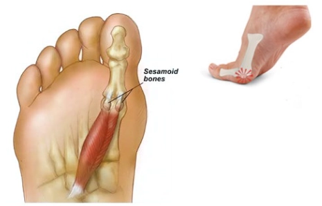 Gãy xương vừng ngón cái (Hallux sesamoid fracture) 