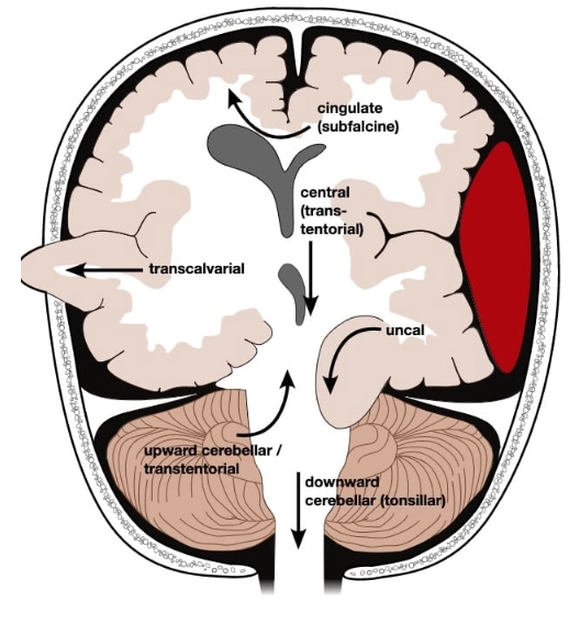 Thoát vị trung tâm (Central Herniation)-Thoát vị xuyên lều xuống dưới hai bên (Bilateral Descending Transtentorial Herniation)