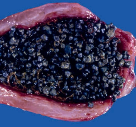 Sỏi bùn túi mật (Gallbladder sludge)