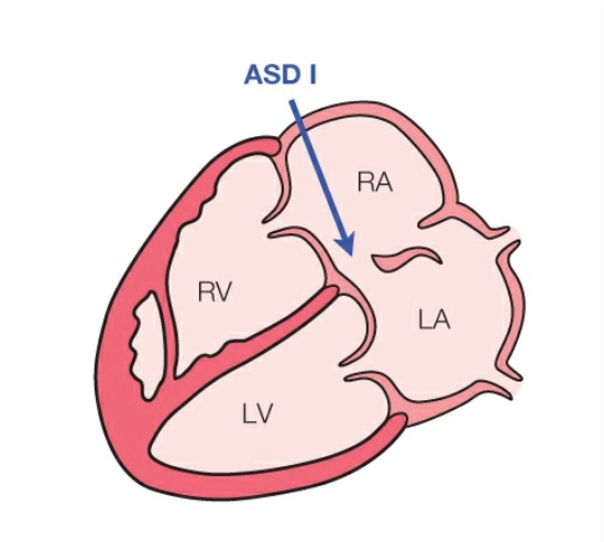 Thông liên nhĩ lỗ nguyên phát (ASD I) - Kênh nhĩ thất bán phần (Partial AVSD)