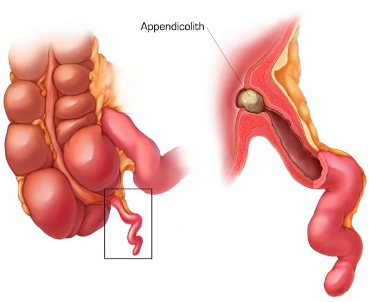 Sỏi ruột thừa (Appendicolith)