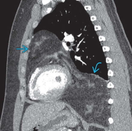 U mỡ tuyến ức (Thymolipoma)