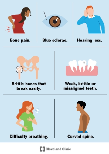 Bệnh tạo xương bất toàn/ Xương thủy tinh (Osteogenesis Imperfecta - OI)