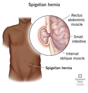 Thoát vị bụng bên (Spigelian Hernia)