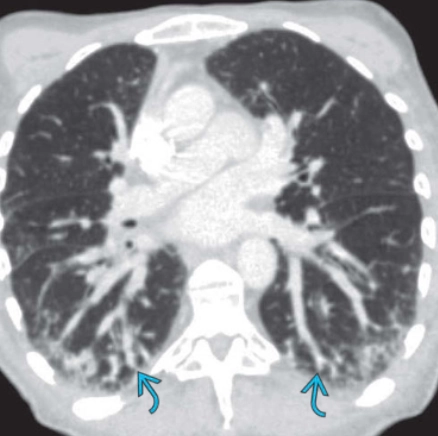 Hội chứng gan-phổi (Hepatopulmonary syndrome - HPS)