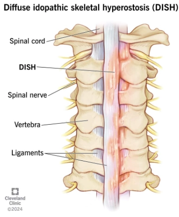 Tăng sản xương lan tỏa vô căn (Diffuse Idiopathic Skeletal Hyperostosis - DISH)
