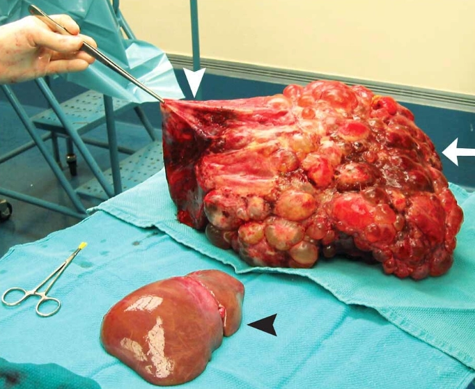 Bệnh gan đa nang (Polycystic Liver Disease - PCLD)