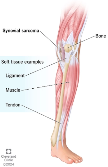Sarcoma bao hoạt dịch (Synovial sarcoma)