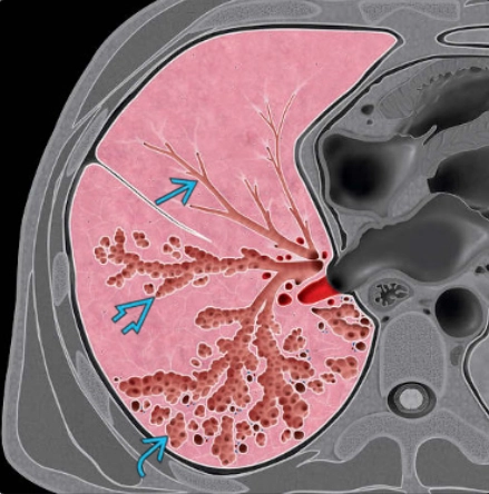 Giãn phế quản (Bronchiectasis)