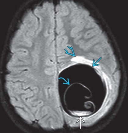 Bệnh Nang sán chó ở não (Neurohydatidosis) 