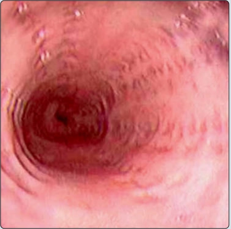 Giả túi thừa (Intramural Pseudodiverticulosis)