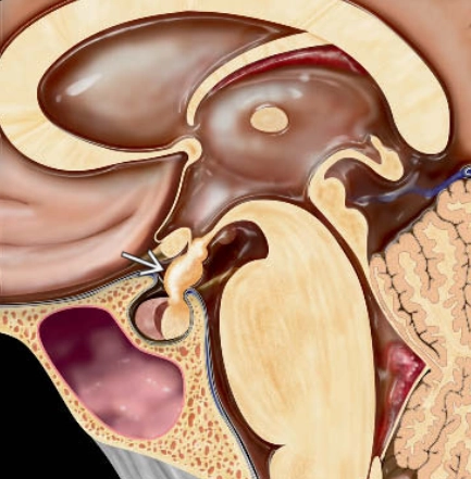 U tế bào tuyến yên (Pituicytoma)