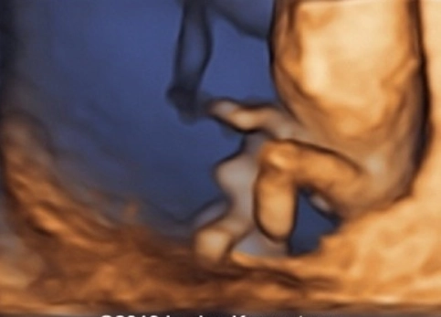 Thiếu hụt xương mác và xương chày thai (Fibular / Tibial Hemimelia)