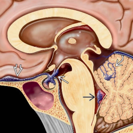 Sarcoidosis thần kinh (Neurosarcoidosis)