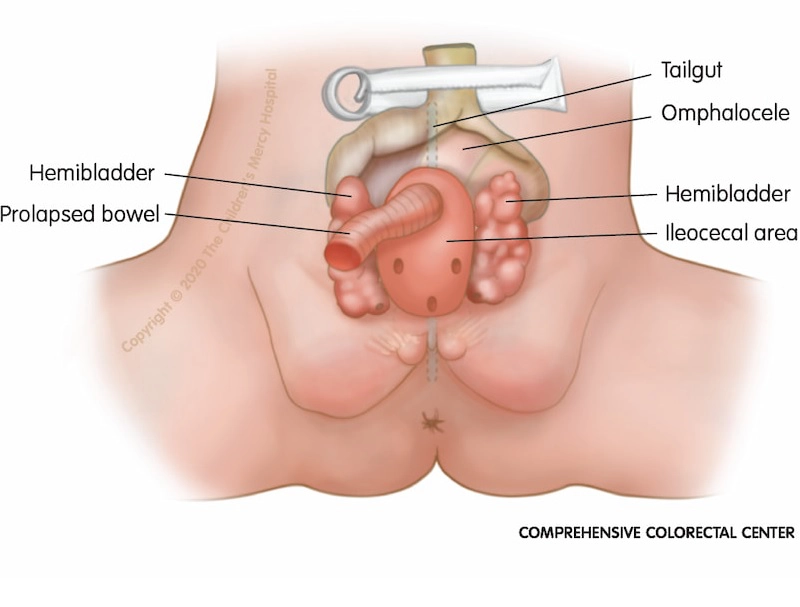 Lộn ổ nhớp/ Hội chứng OEIS: Cloacal Exstrophy/OEIS Syndrome