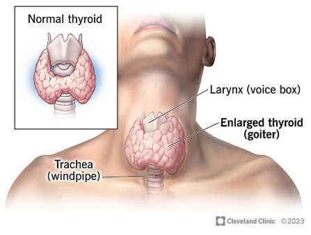 Viêm tuyến giáp Hashimoto (Hashimoto thyroiditis)