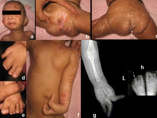 Hội chứng Nevus Tế Bào Đáy (Basal Cell Nevus Syndrome - BCNS )/ Hội chứng Gorlin-Goltz (Gorlin-Goltz syndrome)