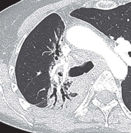 Xẹp phổi do sẹo (Cicatrisation Atelectasis) 