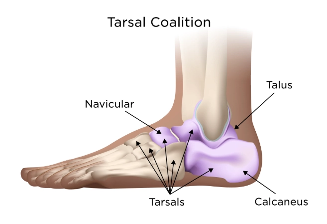 Dính xương cổ chân (Tarsal coalition)