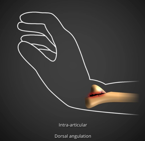Gãy Barton (Barton fracture)