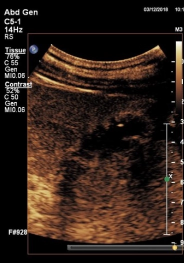Ứ đọng Cholesterol thành túi mật (Gallbladder wall cholesterolosis)