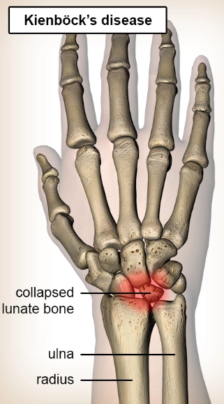 Hoại tử vô mạch xương nguyệt (Kienböck disease)