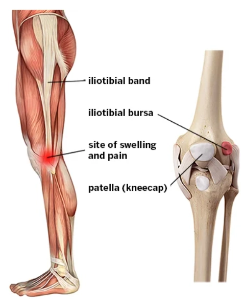 Hội chứng dải chậu chày (Iliotibial band syndrome)