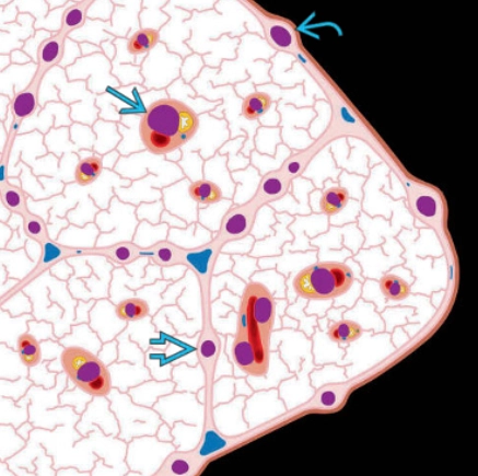 Nốt phổi phân bố theo hệ bạch huyết (Perilymphatic lung nodules)