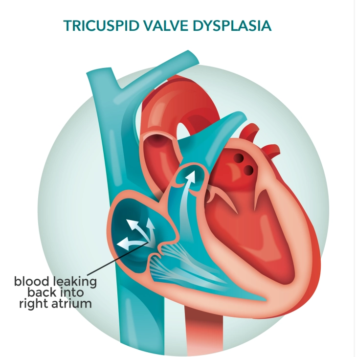 Loạn sản van ba lá