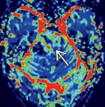 U tế bào thần kinh đệm lan tỏa đường giữa, biến đổi H3 K27 (Diffuse midline glioma, H3 K27-altered)