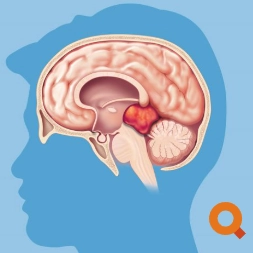 U tế bào mầm ác tính nội sọ (Malignant Intracranial Germ Cell Tumors - Malignant GCT)