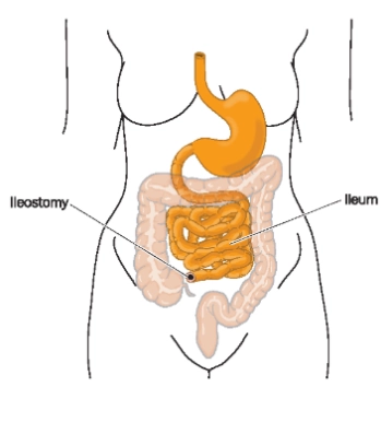 Mở hồi tràng ra da (Ileostomy)