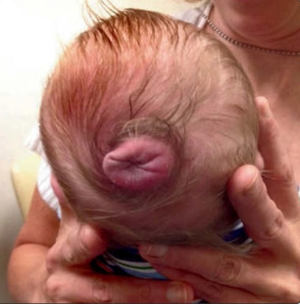 Thoát vị màng não thoái triển thai nhi (Atretic cephalocele)